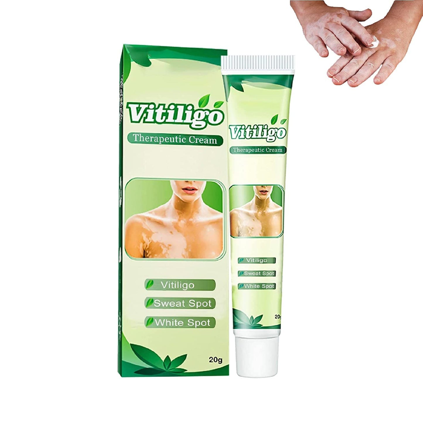 Vitiligo