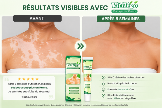 Vitiligo